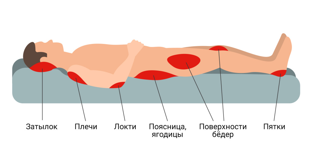 Типичные-места-с-высоким-риском-развития-пролежней-1.jpg Типичные-места-с-высоким-риском-развития-пролежней-1.jpg
