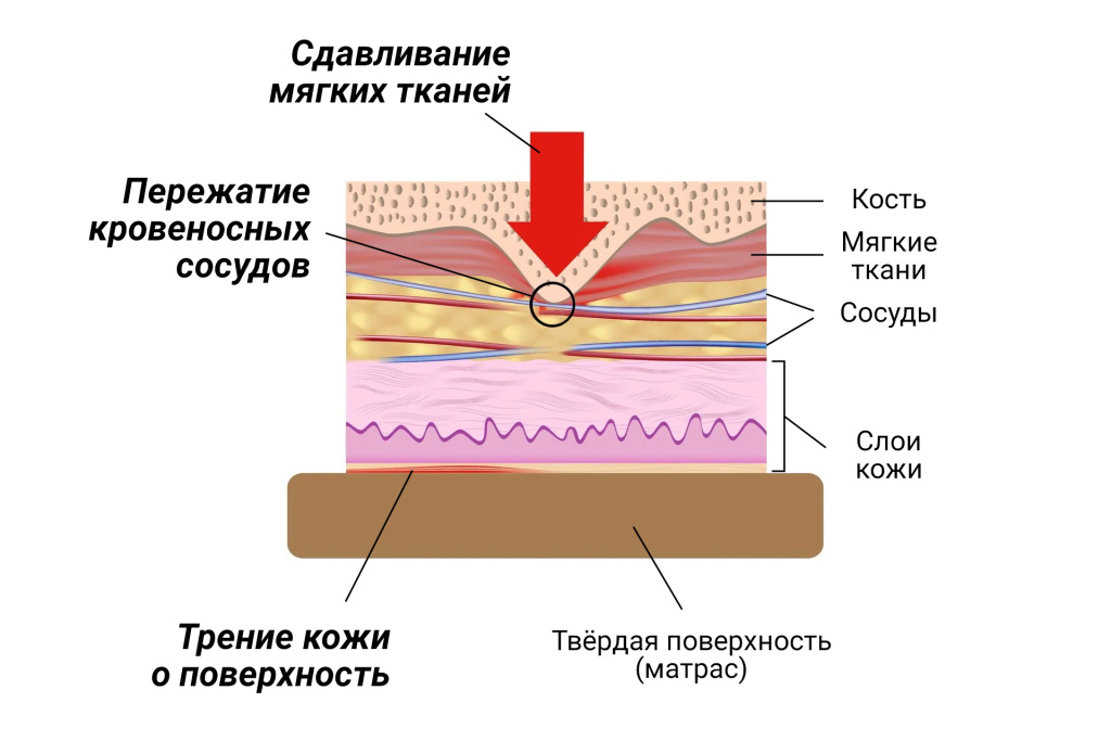Образование пролежней Образование-пролежней-Сдавливание.jpg
